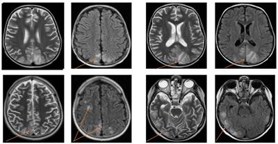 Posterior reversible encephalopathy syndrome in children with malignancies – a single-center retrospective study